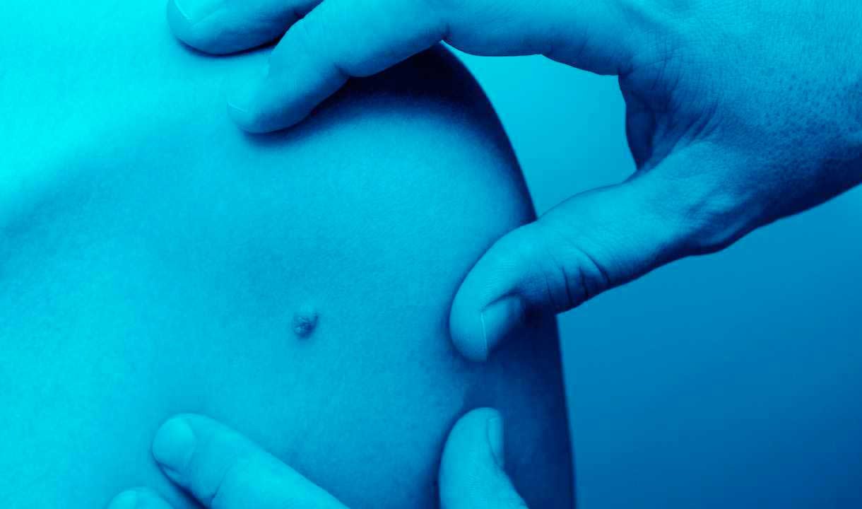 Servicios para la Piel cirugía dermatologica